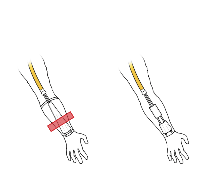 Final sleeve drawings showing the divided tube holder placement on the forearm
